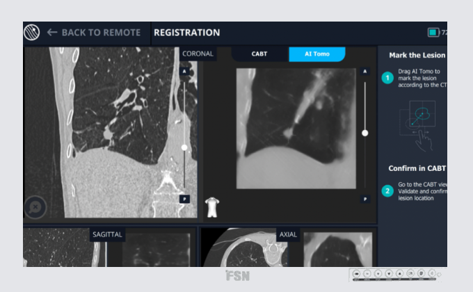 Understanding Intraoperative CT Bronchoscopy | BodyVision